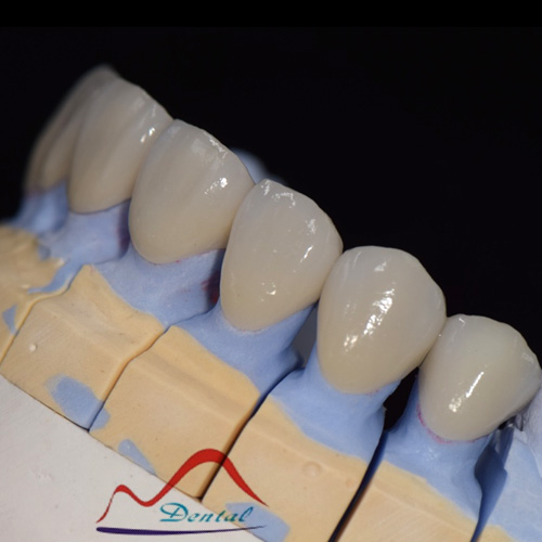 Aesthetics Zirconia Porcelain Bridge b