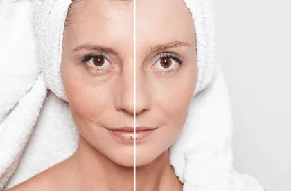 Choicy Micro Needling, Derma Rolling System