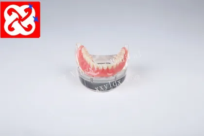 Mandibular Overdenture Implant Teeth Model with 4 Implants