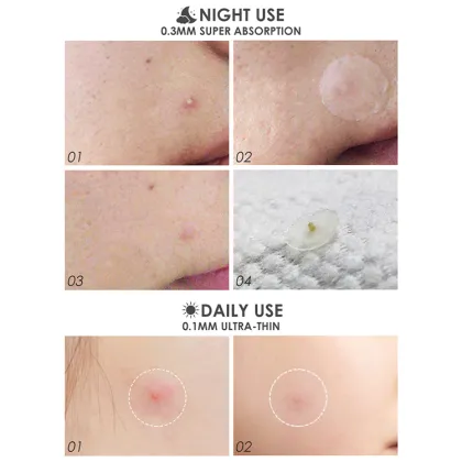 Wholesale Custom Shape Acne Patches with Acne Treatment