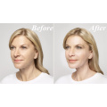 HSKINLIFT 1ML2ML10ML CORSE LINGED HA DERMAL FILLER ВВЕДЕНИЕ