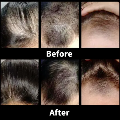 Anti-Hair Loss & Anti-Dandruff Volumizing Shampoo for Hair Growth