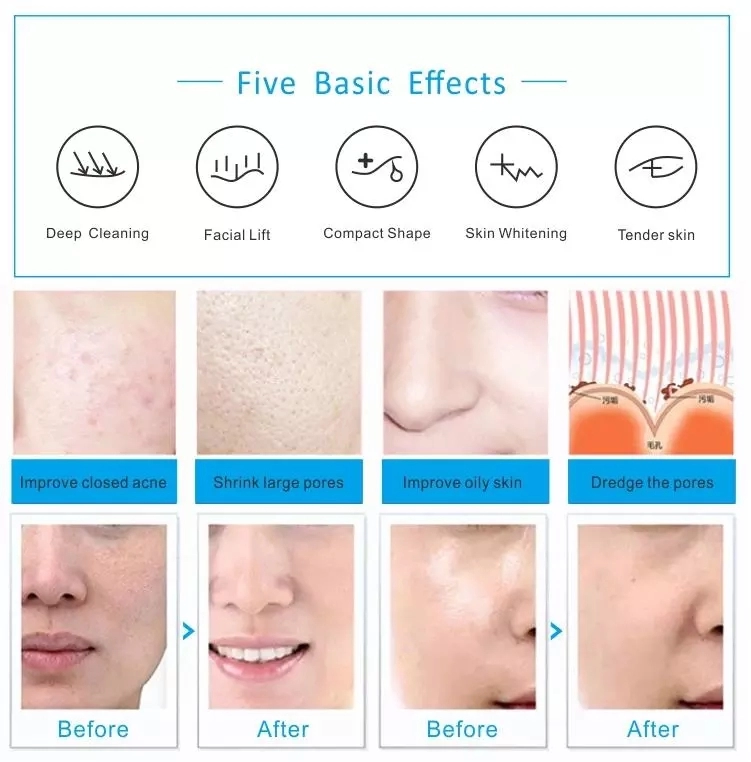 Beauty Salon Use Hydra Facial Microdermabrasion Deep Clear Hydrofacials Machine