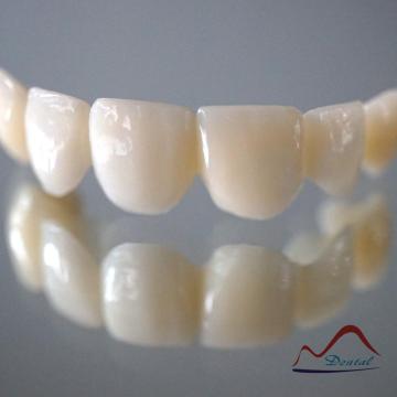 Dental Fixed Temporary Bridge