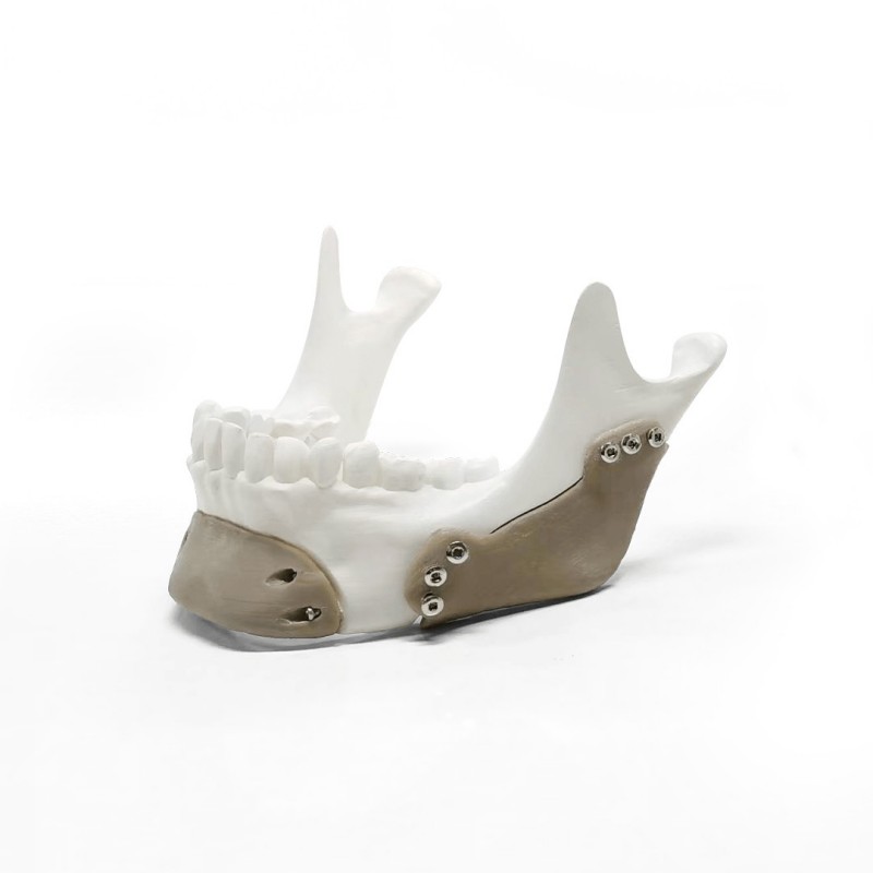 PEEK Implant5