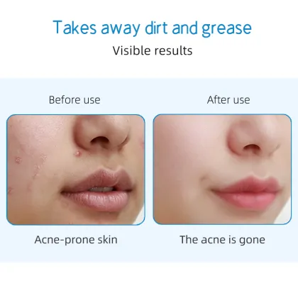 Factory Private Labels Salicylic Acid Anti-Acne Cleanser Face Wash