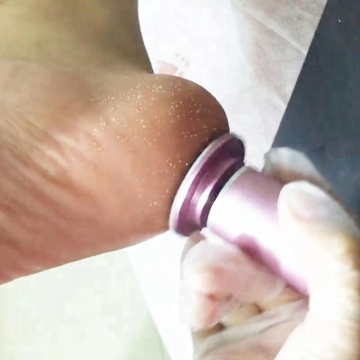 Best Electric Foot File for Callus Removal on Vacation