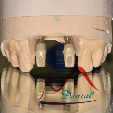Customized Zirconia Abutment in-house Milling Center