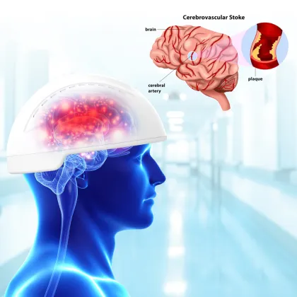 Cerebral migraine cure photodynamic helmet