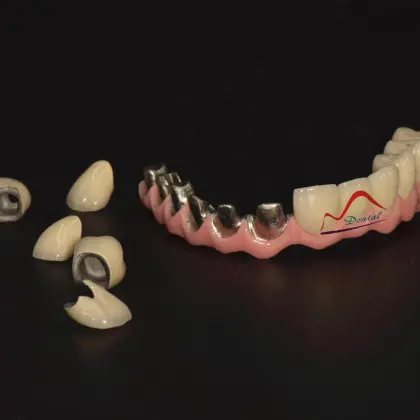 Malo Implant Bridge Restoration