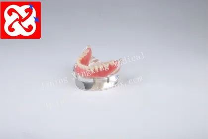 Mandibular Overdenture Implant Teeth Model with 4 Implants