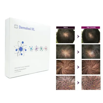 Dermaheal HL Mesotherapy to Improve Hair Loss