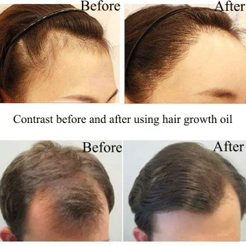 Tratamento de perda de cabelo por atacado Rosemary Hair Growth Oil Serum para cabelos