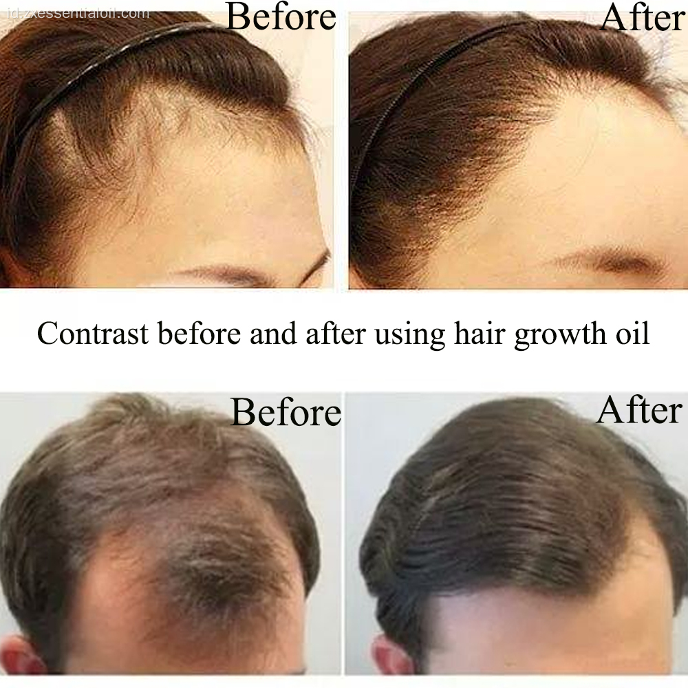 Tanaman murni ekstrak minyak pertumbuhan rambut 100% murni