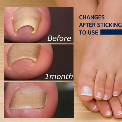 Glue-Free Ingrown Toenail Correction Sticker Patch - Foot Care Treatment