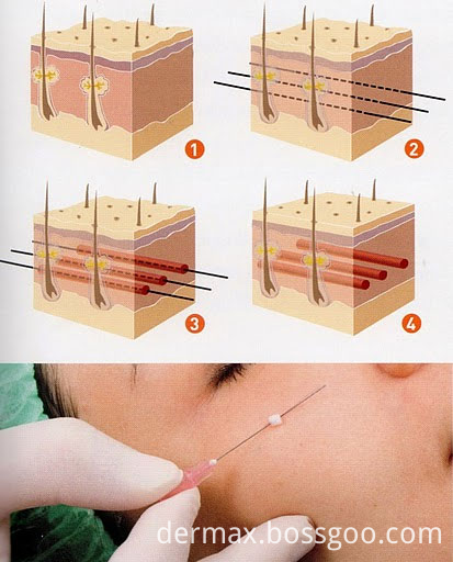 pdo face lifting treatment