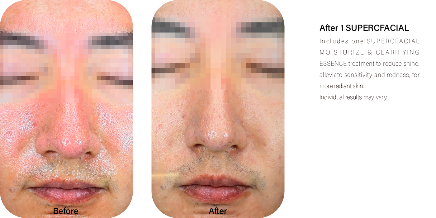 البشرة الدهنية