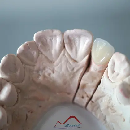 Dental Anterior Zirconia Restoration