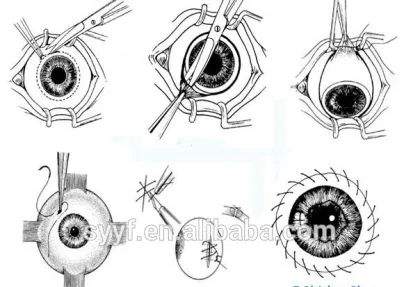 Holman- Thornton fixation ring Standard 16mm surgical instruments