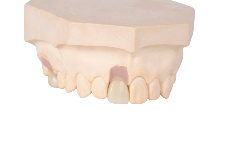 Dental Implant Crown, Dental Implant Zirconia crown,Dental Implant Emax crown,Dental Implant Bridge