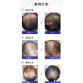 Restylane Hair Growth Medical Beauty Products