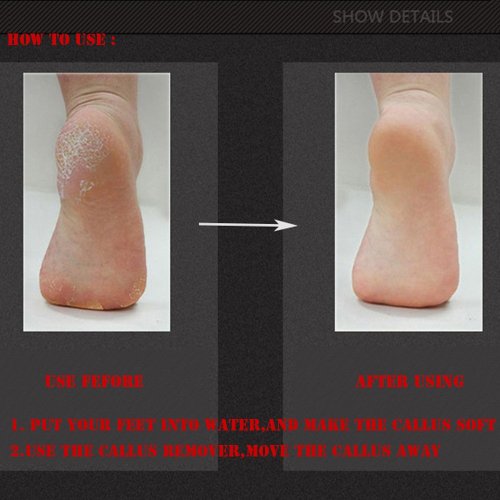 Stainless Steel Foot File and Callus Remover