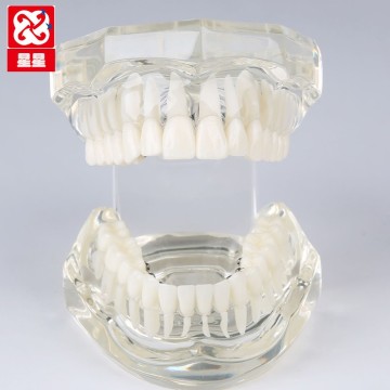 Lingual Brackets Demonstration Model with Arch Wires and Ligature Ties