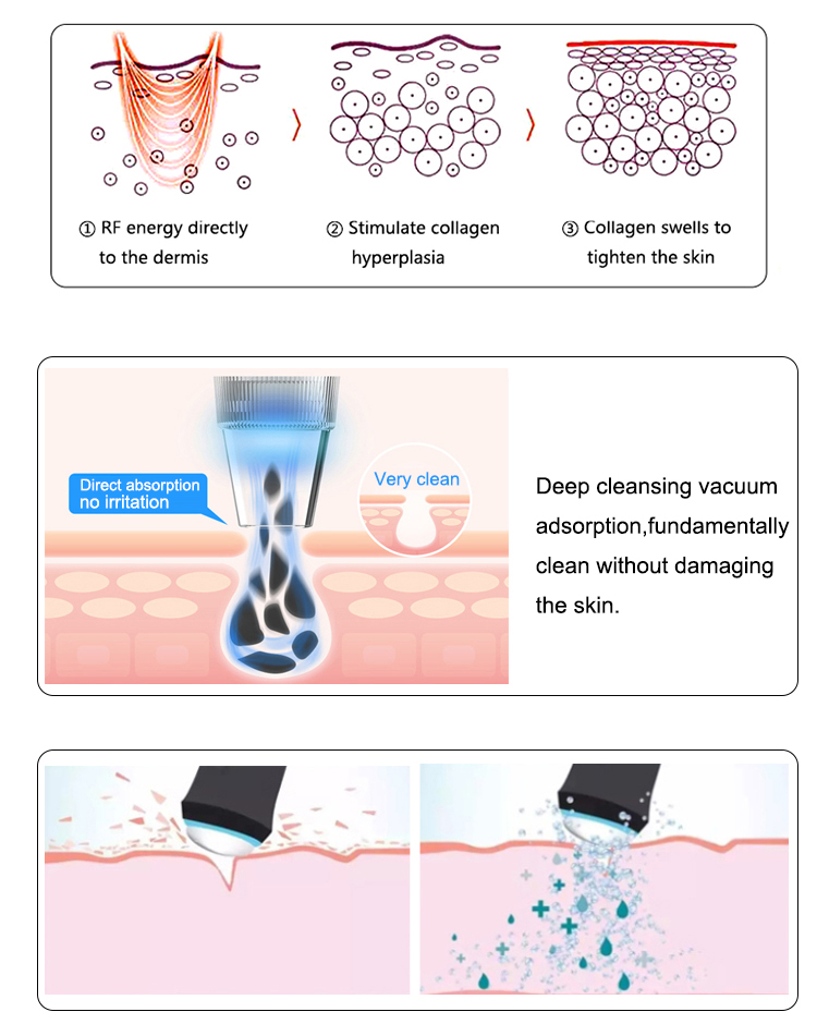 Microdermabrasion Facial Peel