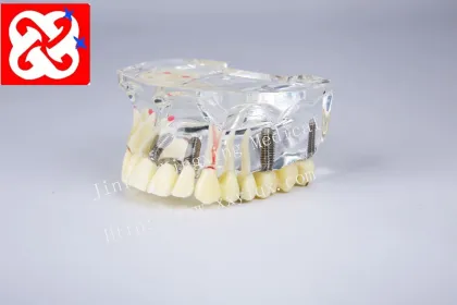 Dental Model Upper Half: Implant and Restoration