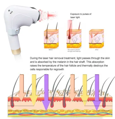 Diode laser permanent hair removal laser skin rejuvenation 808 diode laser hair removal beauty equipment