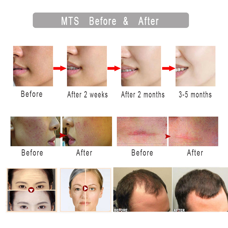 Derma-roller-DRS540-Mezoroller-Micro-Needle-Face-Skin-Care-Hair-Regrowth-Beard-Growth-Anti-Hair-Loss