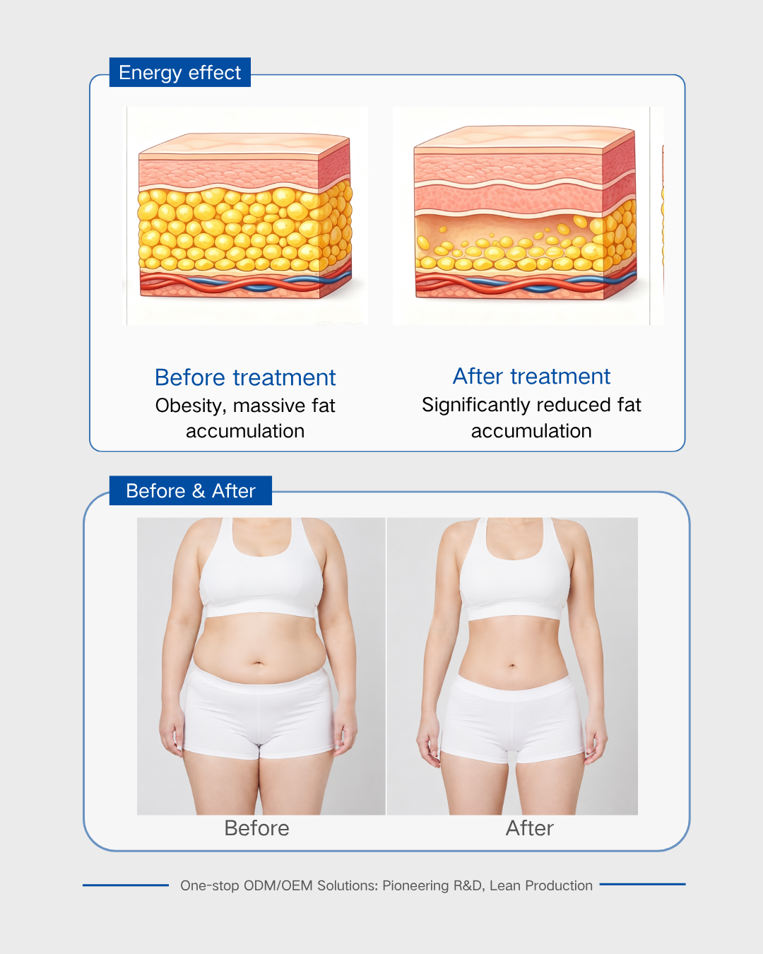 Focused Ultrasound Transducer for Fat Reduction-