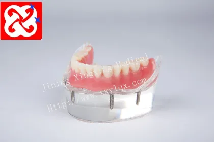 Mandibular Overdenture Implant Teeth Model with 4 Implants
