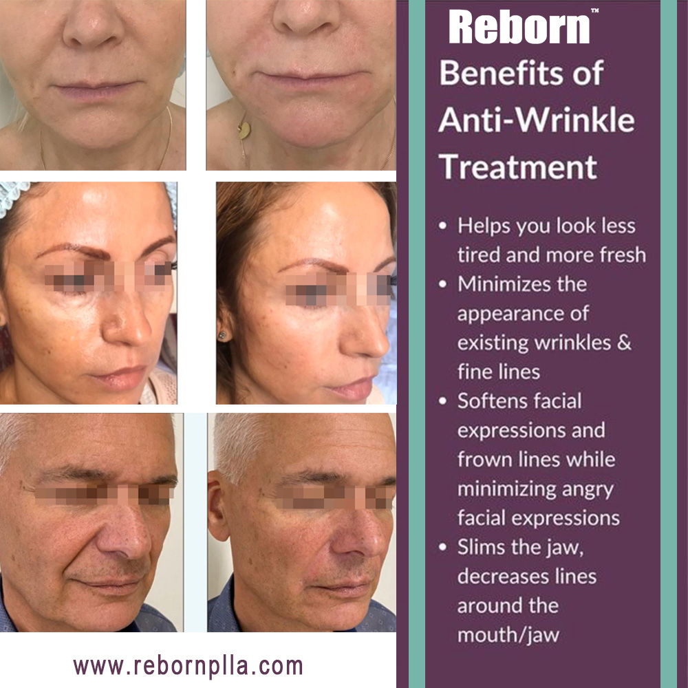 Reborn Benefits of Anti-Wrinkle Treatment
