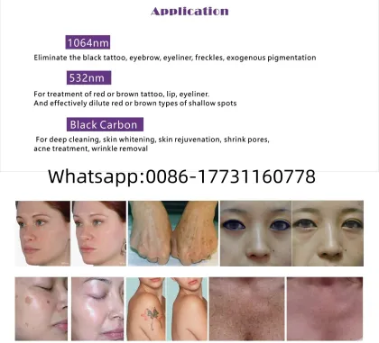 Picosecond ND YAG Laser Eyebrow Pigment Dark Spot Tattoo Removal Laser Machine
