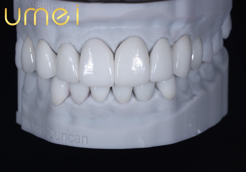 Hollywood White Veneer