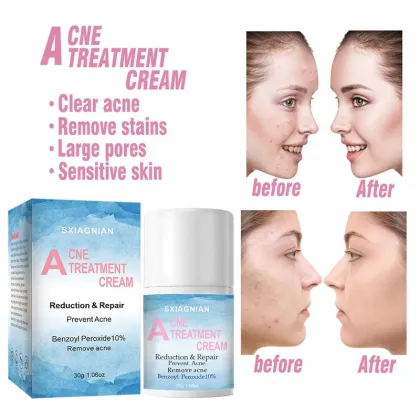 best pimple acne cream for face