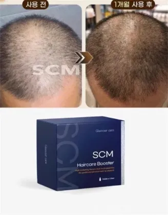 Scm Hair 5*2.5mldr Cyj Hair Filler Aapehair Growth Product Stem Cell Anti Hair Loss Treatment Human Baldness