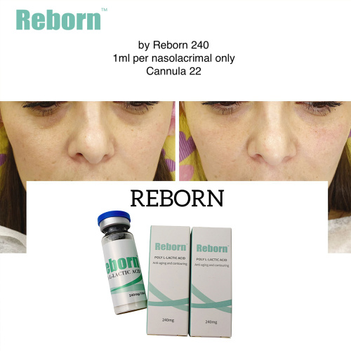 Nasolabial folds removal dermal filler