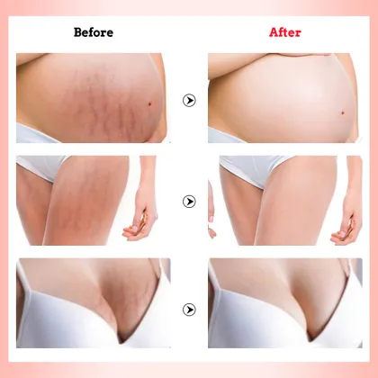 OMYLADY Stretch Marks & Scar Removal Cream