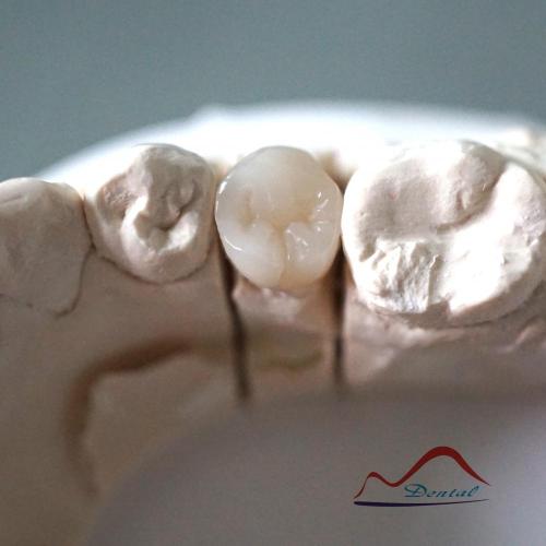 Dental Composite Resin Onlay