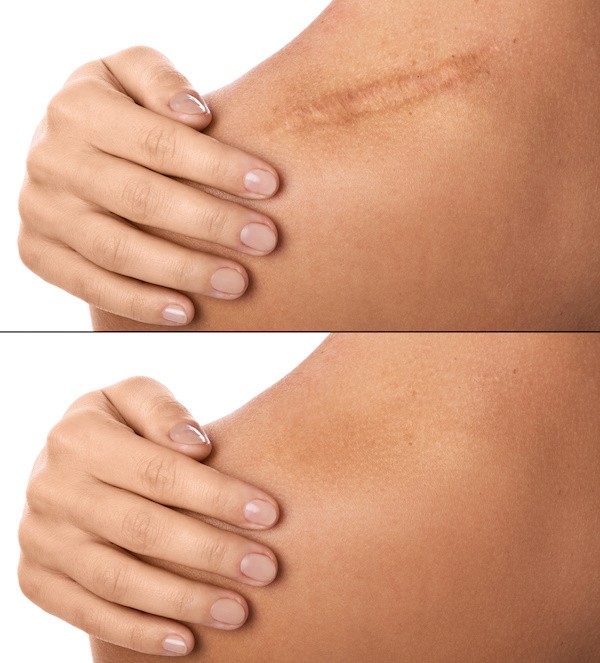 Scar Treatment-Medical Silicone Gel