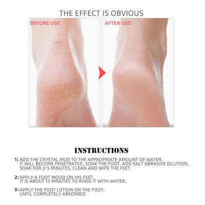 Foot Care: Exfoliating Cream for Rough, Thick, Dry, and Cracked Skin