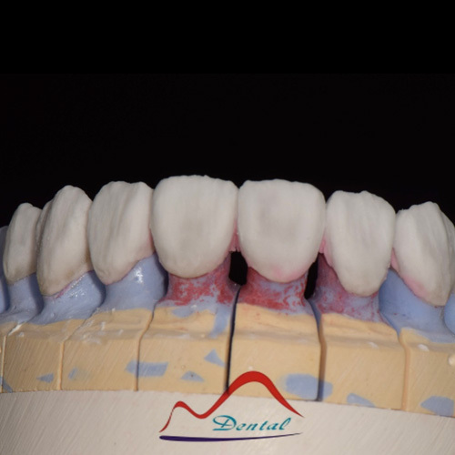 Aesthetics Zirconia Porcelain Bridge