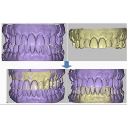 Hand Held Dental 3D Scanner