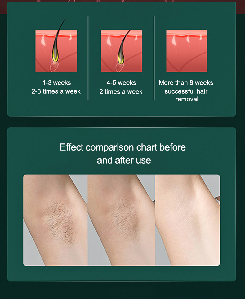 Precise Ice Hair Removal