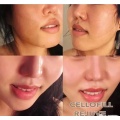 Korea Origin Cellofill Rejuve for Skin Face Reguventing Anti Aging 3ml * 6vials Skin Booster Dermal