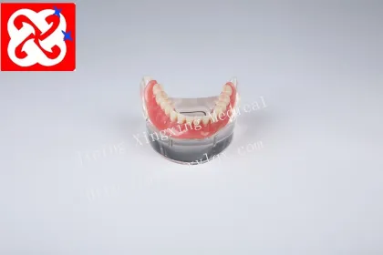 Mandibular Overdenture Restoration with 2 Implants