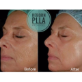 Facial Injections PLLA Hydrogel Filler For Skin Rejuvenation