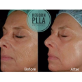 Hot Sale Long-lasting Non-surgical Face Lift Hydrogel